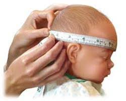 Resultado de imagem para Microcefalia