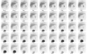 We did not find results for: Biliary Atresia Radiology Case Radiopaedia Org