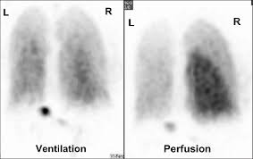 Image result for Ventilation Perfusion Scan