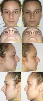Exista doua tipuri de rinoplastie: Rinoplastie Septoplastie ClinicÄƒ ExclusivistÄƒ La Standarde Occidentale