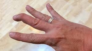 Ideal for trigger finger, mallet finger, broken or fractured finger, sprained knuckles, rheumatoid arthritis, tendonitis , post stroke finger curling. Mallet Finger Causes Symptoms And Treatment