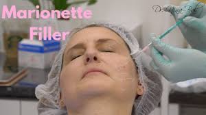 Maybe you would like to learn more about one of these? Marionette Lines Facial Sculpting