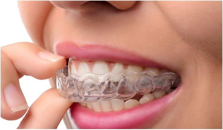 Invisible Aligners / Braces product image