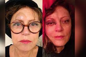 Actress susan sarandon attends the saint laurent presents belle de jour 50th anniversary screening at museum of modern art on december 19, 2018 in. Susan Sarandon Suffers Concussion Fractured Nose After Fall