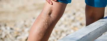 Your center for varicose & spider veins in munich. Varicose Veins Guide Causes Prevention Treatment Dr Mackay In Tampa