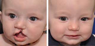 We did not find results for: Cleft Lip Repair Palate Surgery Beverly Hills Los Angeles