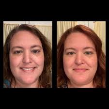 I started using Reverse Lightening a year ago. As you can see I had very  dark spots