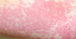 A chlorine rash refers to a kind of skin rash which often occurs after an individual has contact with chlorine. Chlorine Rash Symptoms Causes And Treatment