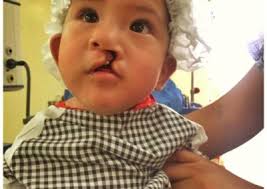 Dr.Gustavo Florez en Dr.Raul Rodriquez opereren schisiskinderen!