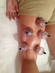 Download Free Photo Of Cupping Acupuncture Alternative Therapy Chinese From Needpix Com