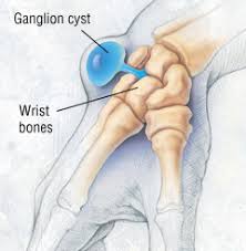 You or your gynecologist may discover a small lump during an a bartholin cyst is caused by a backup of fluid due to a blockage in the bartholin duct. Cysts Overview Harvard Health