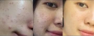 Temen temen pada bilang kalau acne lotion larissa ini worth it banget buat jerawat. Cara Menghilangkan Jerawat Yang Lagi Hits Halaman 1 Kompasiana Com