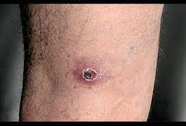 Tick Bite Granuloma Picture Image On Medicinenet Com