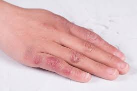 Image result for Chilblains