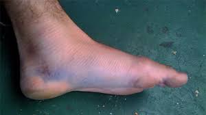 In your diet should be a lot of fresh vegetables and fruits. Lisfranc Fracture Causes Symptoms And Treatments