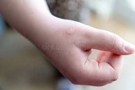 Image result for scabies bite