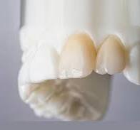 Ultra-Translucent Zirconia (UZir) - SCD