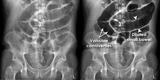 Image result for Adynamic Ileus