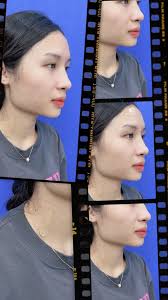 Bệnh viện thẩm mỹ Gangwhoo (@benhvienthammygangwhoo) · Instagram 照片和视频