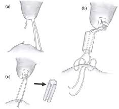 Mitral Valve Repair With Insertion Of Artificial Chordae A The Basal Download Scientific Diagram