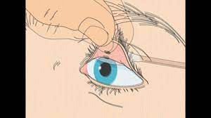 Call a healthcare provider if you are unable to get a foreign object out of. How To Remove A Foreign Body From The Eye Youtube