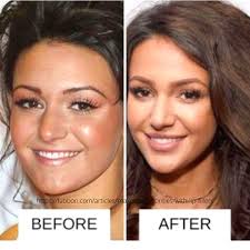 Michelle keegan looks stunning whilst on holiday with the wright family. Vista Clinic Michelle Keegan Lip Job Courtesy Of Fabbon Com Prptreatment Antiaging Dermalfillers Smilelinefiller Lipfillers Lipenhancement Smokerslinesfiller Upperliplines Fillersdublin Lipfillersdublin Prpdublin Prphairdublin