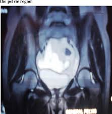 Terminology the nomenclature for this condition can be confusing due to the use of multiple interchangeable different synonyms that put it together with the peritoneal inclus. Benign Multicystic Peritoneal Mesothelioma A Case Report Semantic Scholar