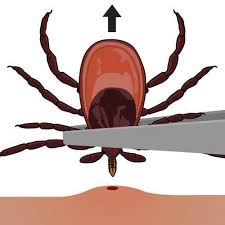Check spelling or type a new query. Tick Removal Ticks Cdc