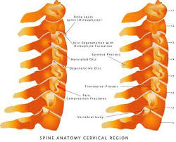 As the disks dehydrate and shrink, signs cervical spondylosis is very common and worsens with age. Cervical Spondylosis Ayurvedic Treatment
