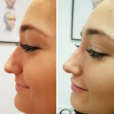 Before committing to rhinoplasty, look through the rhinoplasty before and after photo gallery of nose jobs performed by rhinoplasty experts drs. Non Surgical Nose Job Everything You Need To Know Glamour Uk