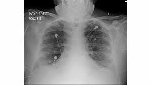 Beranda remdesivir in myasthaenia gravis : Cureus Treatment Experience With Inhaled Corticosteroids In Combination With Remdesivir And Dexamethasone Among Covid 19 Patients Admitted To A Rural Community Hospital A Case Series