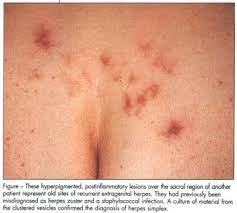 Hsv i and hsv ii. Isolated Thigh Lesion Bug Bite Or Herpes Document Gale Academic Onefile