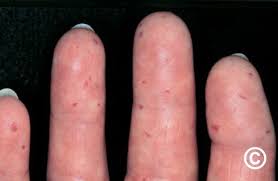 Image result for Systemic Sclerosis