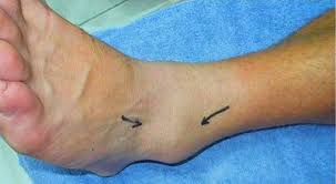 A high ankle sprain is less common in everyday life but can be seen in competitive athletes. Ankle Sprain Treatment