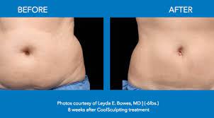 His flanks are flatter as well as more symmetrical. Coolsculpting For Stomach In Nj Freeze Your Stomach Fat Away Today