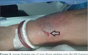 Check spelling or type a new query. Rose And Life Anaphylaxis Following Rose Thorn Prick Injury Semantic Scholar