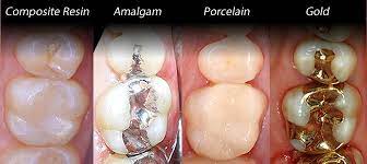 How Long Do Fillings Last Windsor Dentists Dental Fillings Tooth Filling Dental