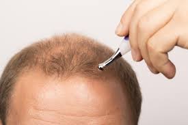 Hair care tips for a receding hairline. Receding Hairline Treatment Stages And Causes