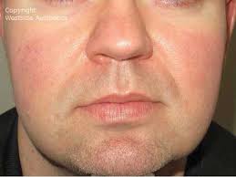 Check spelling or type a new query. Rosacea And Skin Pigmentation Westside Aesthetics
