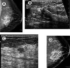 Early warning signs of inflammatory breast cancer along with images of inflammatory breast cancer are mentioned below. Staging Of Breast Cancer With Ultrasound Sciencedirect