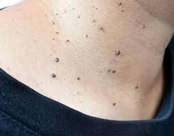 Pegang boleh, ambil tak boleh? Skin Tag Boleh Ganggu Penampilan Anda Awas Elak Buang Sendiri Mode Mstar