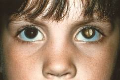 Among children, it is the most common malignant tumor that starts in eye. Photos Can Help Diagnose Children S Eye Problems And Save Sight American Academy Of Ophthalmology