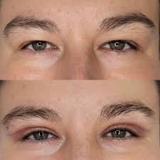 Plastyka powiek górnych otwiera oczy.