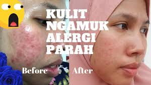 Penyakit kulit eksim lebih dari sekedar kulit kering dan gatal. Tuty Saca Caraku Mengatasi Kulit Alergi Merah Gatal Jerawat Iritasi Kulit Sensitif