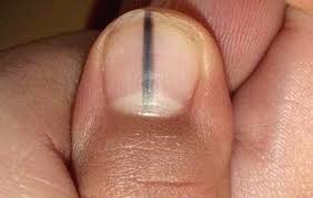 This Woman S Story Shows Why You Should Never Ignore A Black Line On Your Nail Black Marks On Nails Nail Health Nail Symptoms