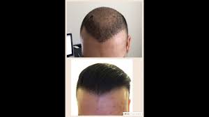How much hair grafts can be transplanted in one day? How Many Grafts Do I Need To Get A Dense Hair Transplant Laptrinhx News