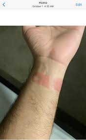 (of course, we already got your money.) for a wearables company to admit that you might have to stop wearing their product is really bad. My Apple Watch Series 6 Band Burned Me Macrumors Forums