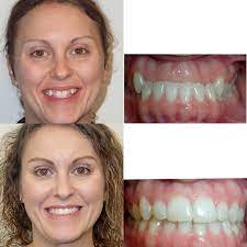 Maybe you would like to learn more about one of these? Before After Braces Wazio Orthodontics