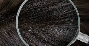 Image result for lice vs dandruff