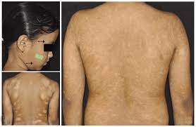Treatment consists primarily of trigger avoidance, good general skin care, and education of the patient's parents about the benign nature of this. Differential Diagnosis For Vitiligo A Pityriasis Alba Arrows And Download Scientific Diagram
